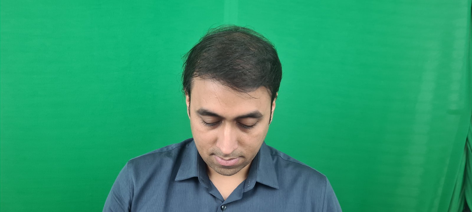 Utsav Aman After Hair Transplant